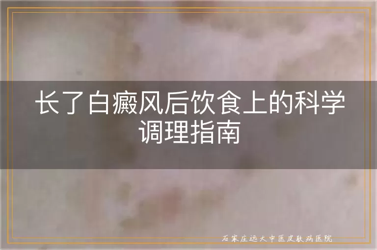 长了白癜风后饮食上的科学调理指南