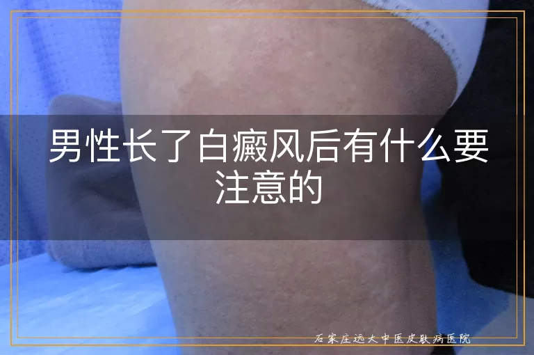 男性长了白癜风后有什么要注意的