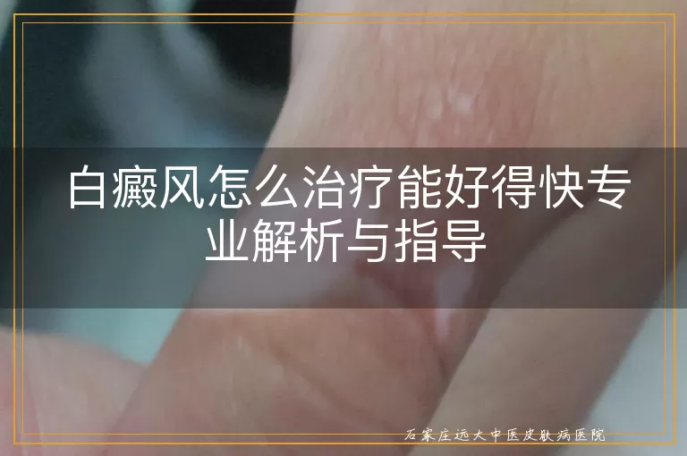 白癜风怎么治疗能好得快专业解析与指导