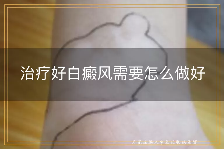 治疗好白癜风需要怎么做好