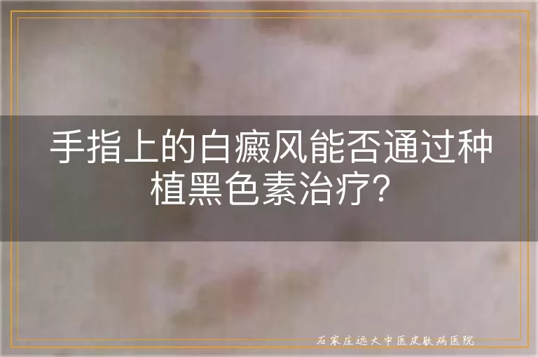 手指上的白癜风能否通过种植黑色素治疗？