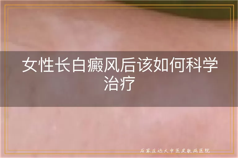 女性长白癜风后该如何科学治疗