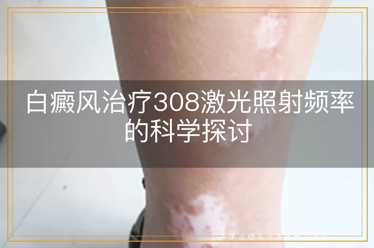 白癜风治疗308激光照射频率的科学探讨