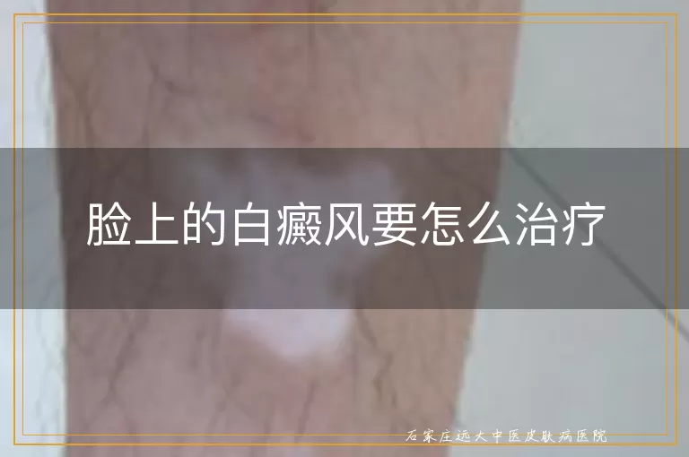 脸上的白癜风要怎么治疗