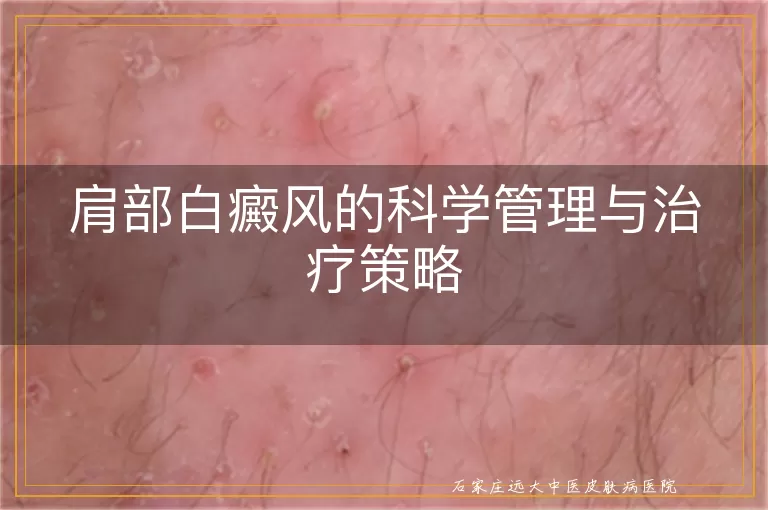 肩部白癜风的科学管理与治疗策略