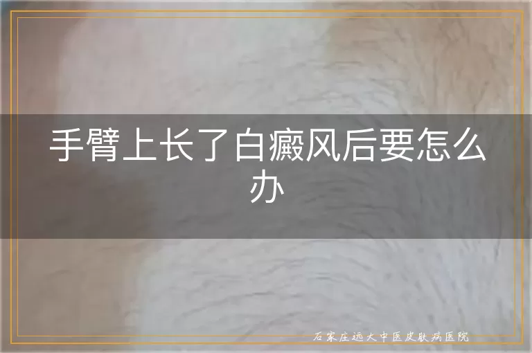 手臂上长了白癜风后要怎么办