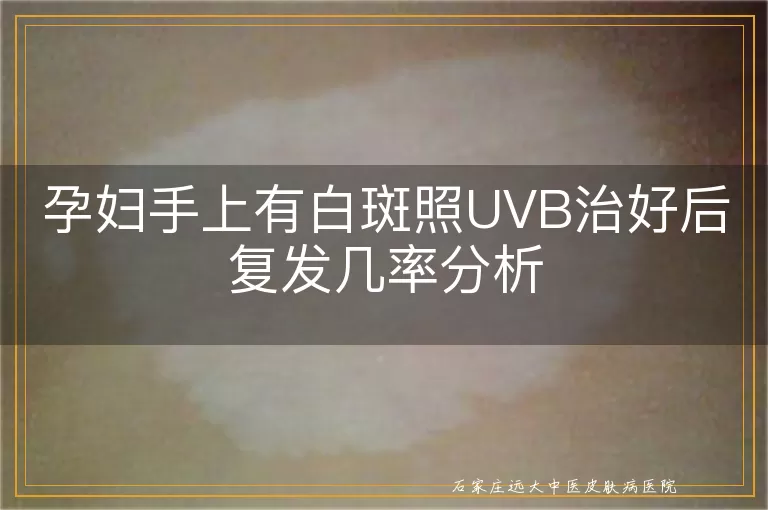 孕妇手上有白斑照UVB治好后复发几率分析