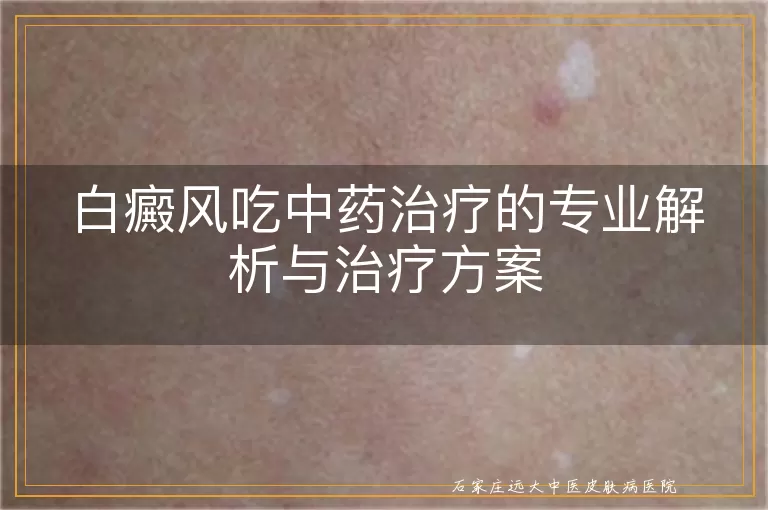 白癜风吃中药治疗的专业解析与治疗方案