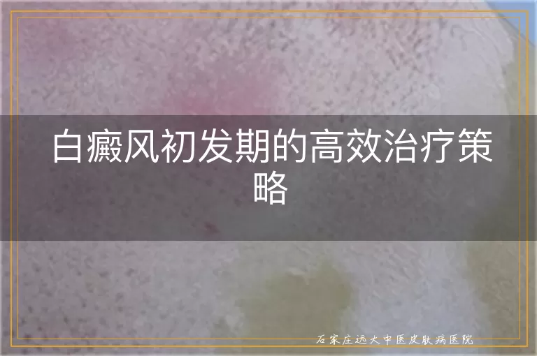 白癜风初发期的高效治疗策略