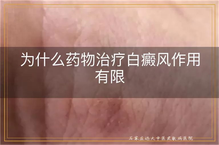 为什么药物治疗白癜风作用有限