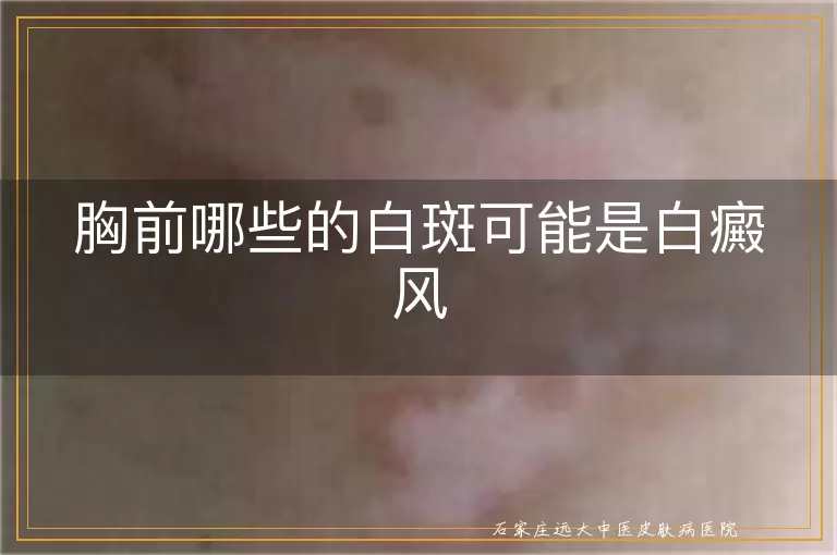 胸前哪些的白斑可能是白癜风