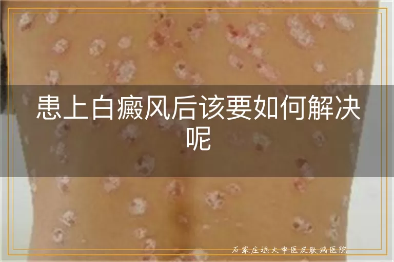 患上白癜风后该要如何解决呢