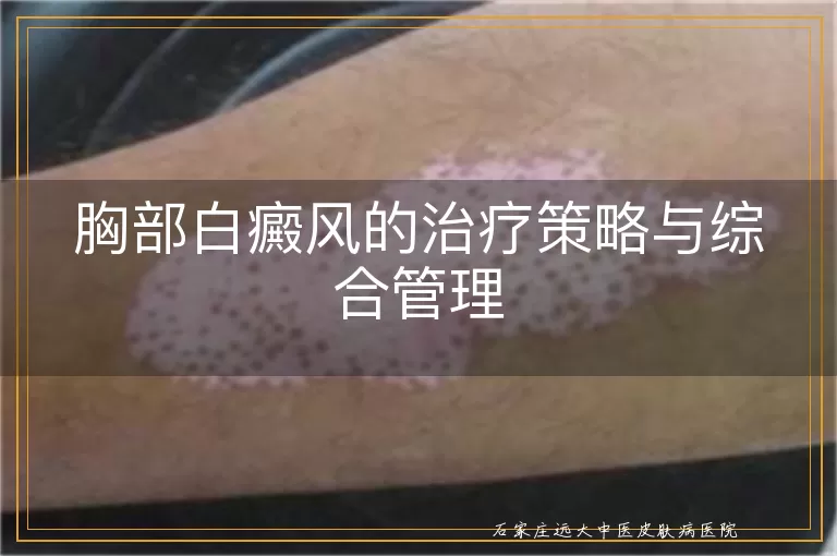 胸部白癜风的治疗策略与综合管理