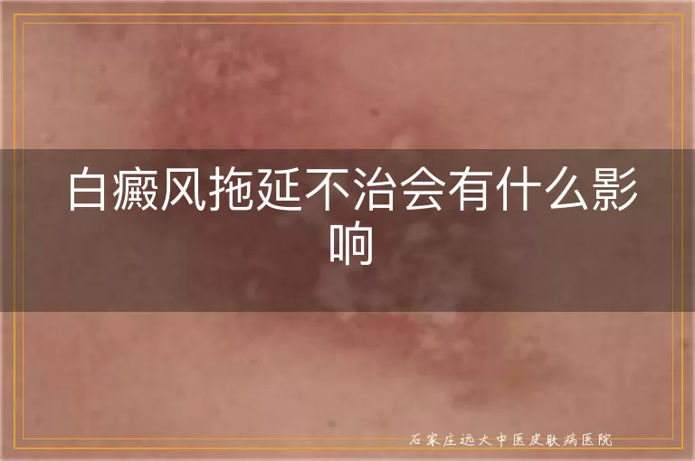 白癜风拖延不治会有什么影响