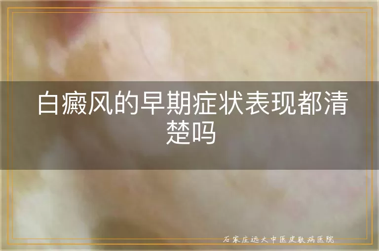 白癜风的早期症状表现都清楚吗