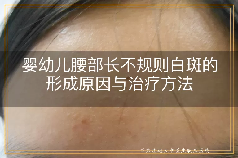 婴幼儿腰部长不规则白斑的形成原因与治疗方法