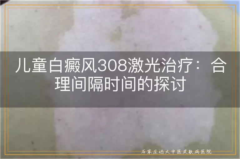 儿童白癜风308激光治疗：合理间隔时间的探讨