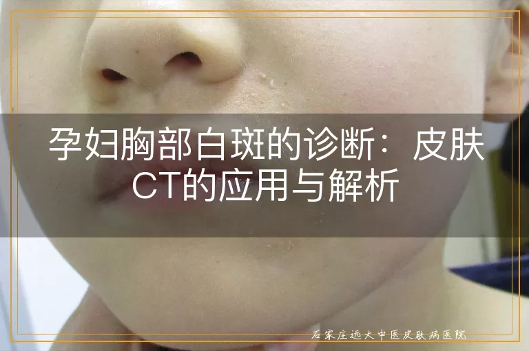 孕妇胸部白斑的诊断：皮肤CT的应用与解析