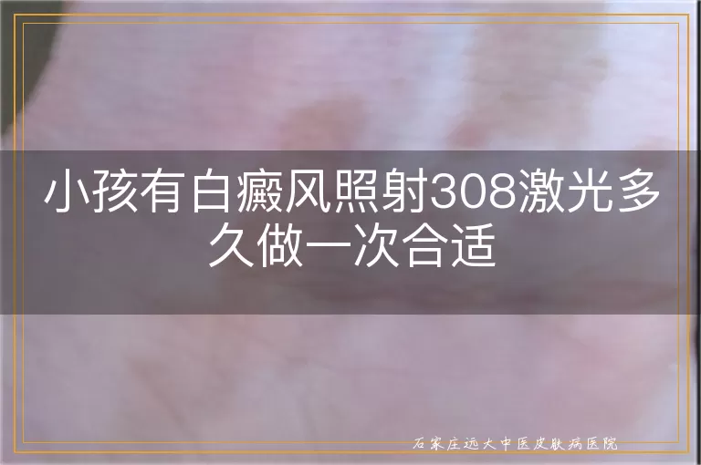 小孩有白癜风照射308激光多久做一次合适