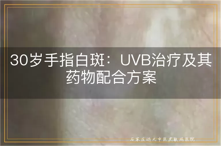 30岁手指白斑：UVB治疗及其药物配合方案